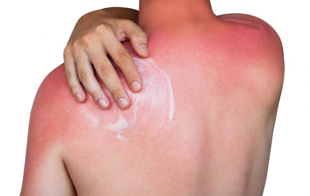 sunburn-on-a-mans-back